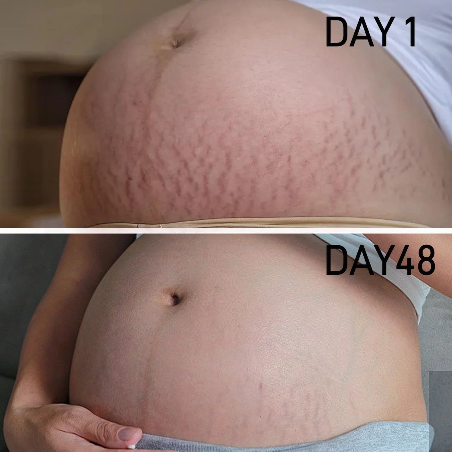 AOAO Maternity Body Oil for Stretch Mark Prevention & Reduction, Hydrating Skin Care | Stretch Mark Cream for Pregnancy | Repair, Firming & Smoothing Fine Lines Essence Oil (1_Pack/100ml)