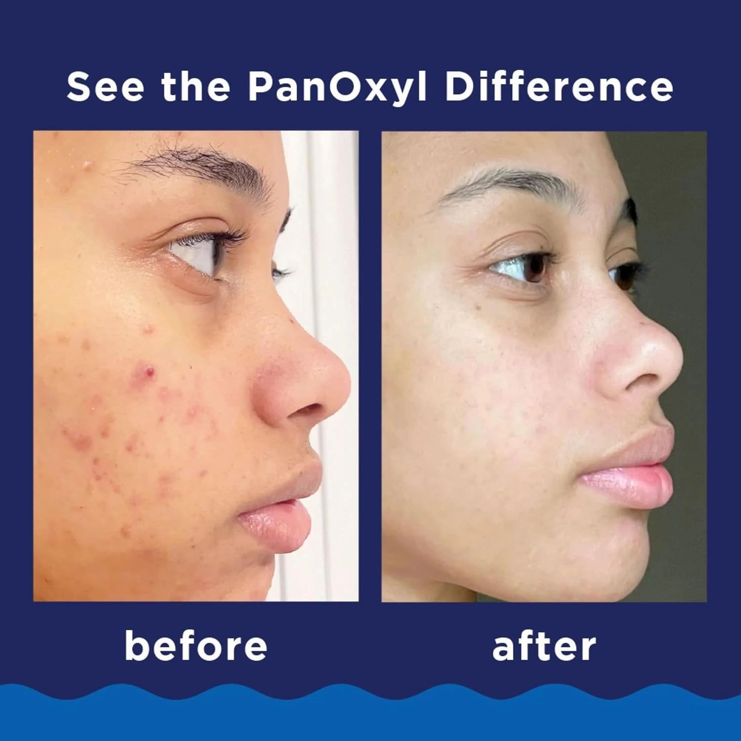 PanOxyl Acne Foaming Wash, 10% Benzoyl Peroxide 5.5 Ounce (Value Pack of 6)